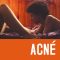 Acne | Acné